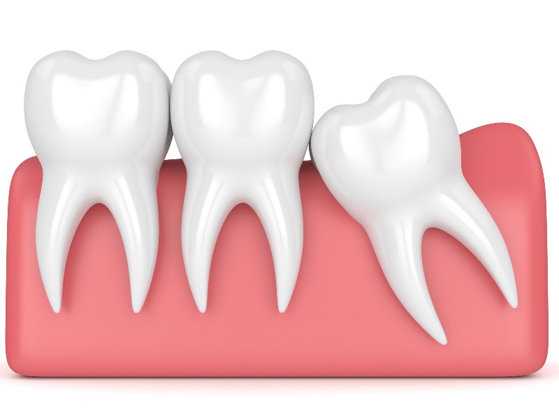 5f482b2c67d0ad7c9c7e6147 5ed82250ec8bb0ee6c5bb882 impacted tooth 1 - JAX Dental Studio
