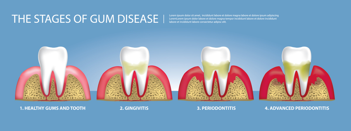 Human teeth Stages of Gum Disease Vector Illustration